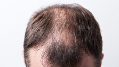 Photo of Przeszczep włosów – sposób na łysienie